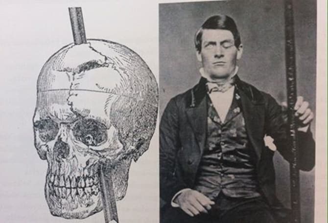 Phineas Gage