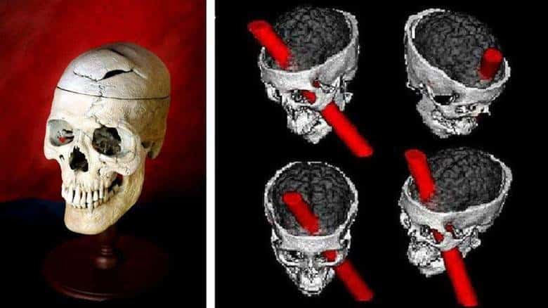 Phineas Gage: Psikoloji Ve Sinirbilimin En Ünlü Hastası