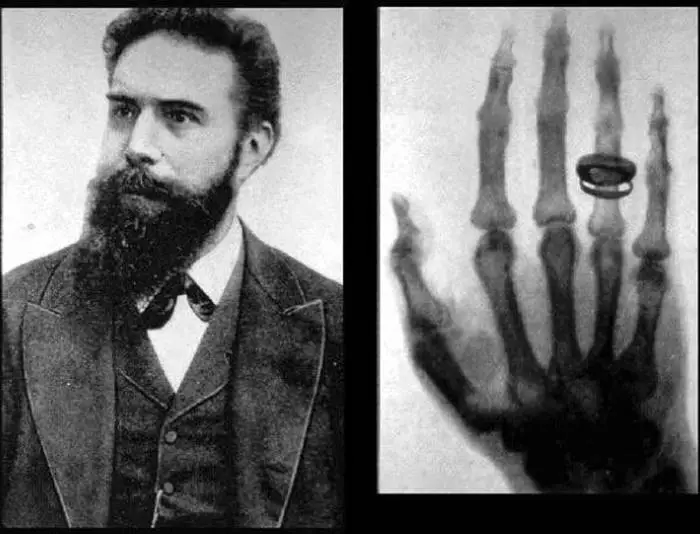X Işını Nedir? Wilhelm Röntgen X Işınlarını Nasıl Keşfetmişti?