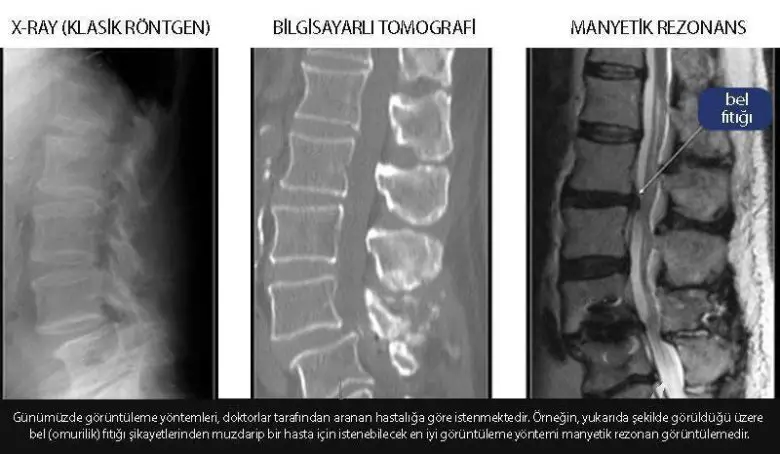 Bilgisayarlı Tomografi İçin Beatles'ın Plak Şirketinde Çalışan Godfrey Hounsfield İsimli Bir Mühendise Teşekkür Etmeliyiz