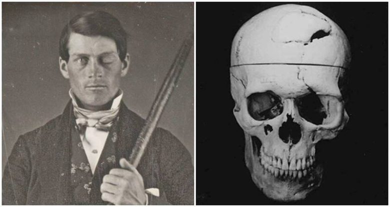 Phineas Gage: Psikoloji Ve Sinirbilimin En Ünlü Hastası