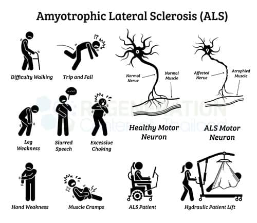 ALS Hastalığı Nedir?