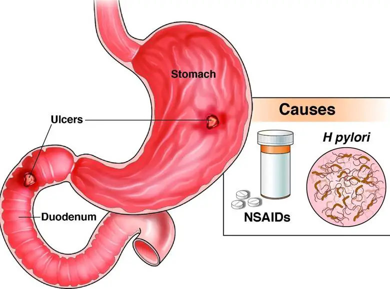 Helikobakter Pilori Bakterisi Ve Ülser