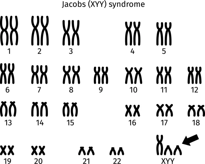 Jacob (47, XYY) Diğer Adıyla Süper Erkek Sendromu Nedir?