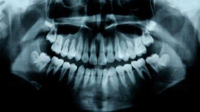 üçüncü diş seti