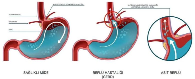 Bir Hıçkırık Sorunsalı: Neden ve Nasıl Hıçkırıyoruz?